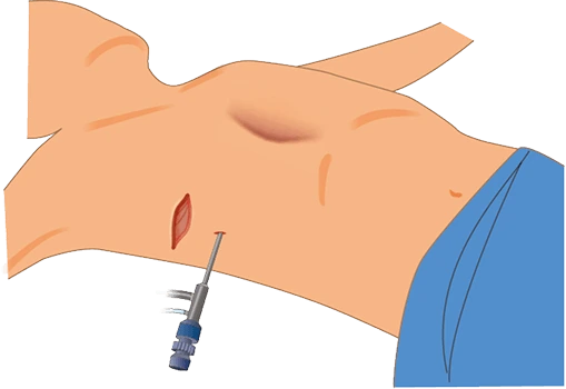 小さな切開部から、バーを通すルートを作成します。