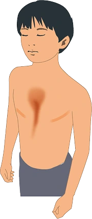 漏斗胸のある胸部