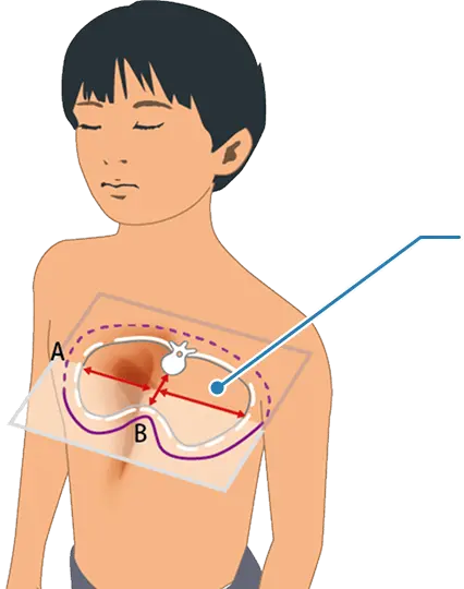 赤い矢印はハラー指数の計測ラインを示しています。