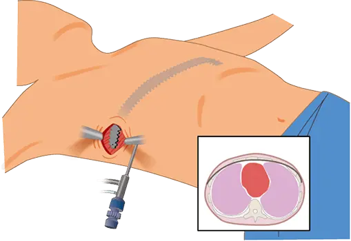 胸の裏側を通して湾曲したバーを挿入し、180°ひっくり返すことで、胸の内部から押し上げて矯正します。（右下の断面図は、術後に胸骨が自然な位置へ戻った状態を示しています）