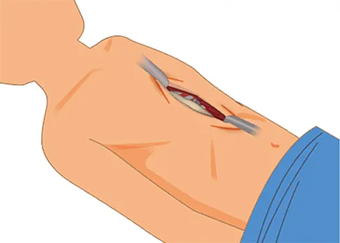 ラビッチ法では、胸骨や肋軟骨を直接切ることで胸の形を整えます。